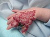 
<p><strong>Haemangioma on the hand<br />
</strong>This photograph shows the haemangioma at approximately 14
weeks old, with painful ulceration. Propranolol not available at
this time. Ulceration being treated by the GOSH treatment plan.
Read more about looking after a <a href="/{localLink:1088}"
title="Protecting your birthmark">ulcerated haemangiomas.<br />
</a> <strong>2 of 4</strong></p>

<p><a href="/{localLink:1088}"
title="Protecting your birthmark">&nbsp;</a></p>
