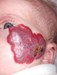 
<p><strong>Haemangioma&nbsp;on face<br />
</strong>Photograph taken at 8 weeks. Propranolol started. First
signs of ulceration.<br />
 <strong>2 of 7</strong></p>

