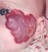 
<p><strong>Haemangioma&nbsp;on face</strong>&nbsp;<br />
Photograph taken at 9 weeks. Propranolol started. Ulceration
underway. GOSH guidelines being followed on <a
href="http://www.gosh.nhs.uk/medical-conditions/procedures-and-treatments/cleaning-and-dressing-ulcerated-haemangiomas/"
 target="_blank">treating an ulcerated haemangioma</a>.<br />
 <strong>3 of 7</strong></p>
