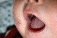 
<p><strong>Venous malformation<br />
</strong> Showing the lip and inside of mouth. Approximate age in
photo 6 weeks. VM darkening since birth. No treatment being given
at this point.<br />
 <strong>2 of 6</strong></p>

