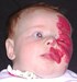 
<p><span><strong>Facial and sub-glottic haemangioma</strong><br />
</span> 6 weeks old.&nbsp;<span>Emergency tracheostomy fitted at 5
weeks<br />
 <strong>1 of 4&nbsp;</strong></span></p>
