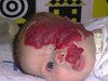 
<p><strong>Facial and sub-glottic haemangioma</strong><br />
8 weeks old.&nbsp;Started on oral <span>steroids</span><br />
<strong>2 of 4&nbsp;</strong></p>
