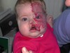 
<p><strong>Facial and sub-glottic haemangioma</strong><br />
 5 months. Still taking oral&nbsp;steroids. The haemangioma has
gone through some ulceration.<br />
 <strong>3 of 4&nbsp;</strong></p>
