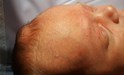 
<p><strong>Haemangioma on frontal fontanelle.</strong><br />
 Picture taken at 4 weeks, swelling appeared in days.<br />
 <strong>2 of 6 &nbsp;</strong></p>
