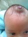 
<p><strong>Haemangioma on frontal fontanelle.</strong><br />
 Picture taken at 6 weeks, still growing<br />
 <strong>3 of 6 &nbsp;</strong></p>
